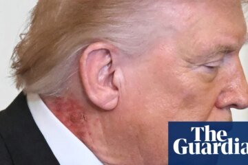 Trump neck rash from ‘preventative’ skin treatment, White House says | Donald Trump