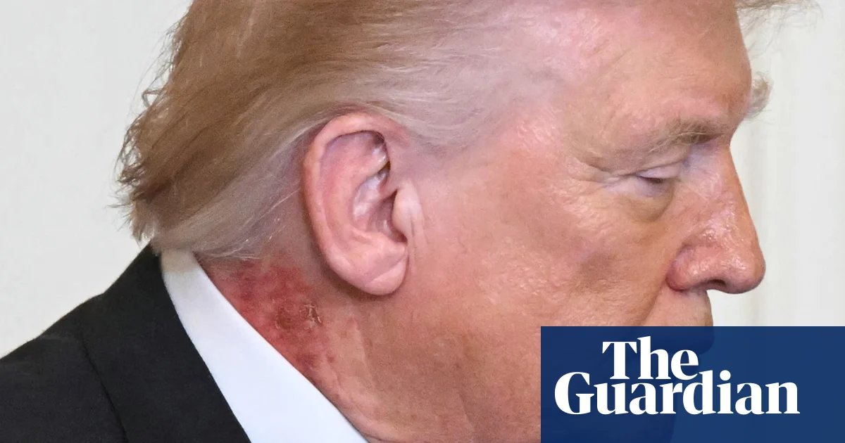 Trump neck rash from ‘preventative’ skin treatment, White House says | Donald Trump